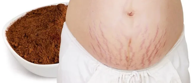 Agar Stretch Mark Hilang Perlahan, Jangan Lupa 8 Cara Ini Diterapkan! 9