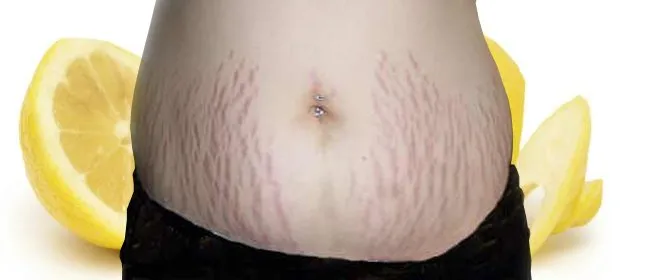 Agar Stretch Mark Hilang Perlahan, Jangan Lupa 8 Cara Ini Diterapkan! 11