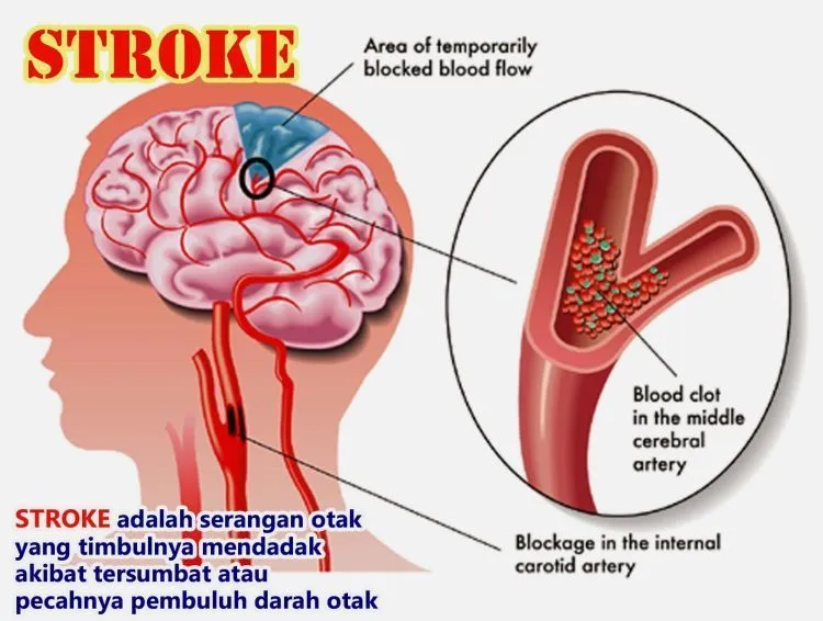 Kesemutan Tak Boleh Diremehkan! 12 Cara Ini Akan Mencegahnya Kembali Datang 26