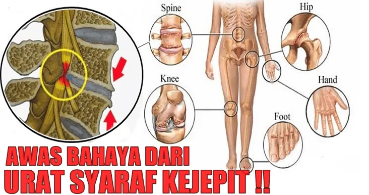 Kesemutan Tak Boleh Diremehkan! 12 Cara Ini Akan Mencegahnya Kembali Datang 28