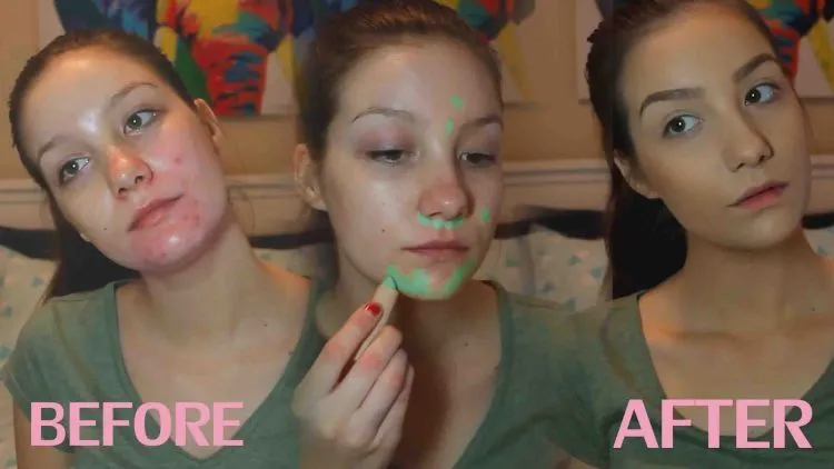 Tips Bermakeup Meski Kulit Sedang Berjerawat. Agar Tidak Semakin Parah 11