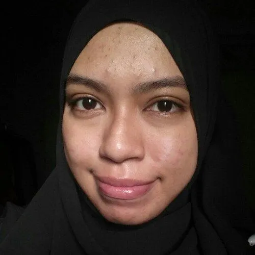 13 Sebab Kenapa Jerawat & Bekasnya Susah Hilang 25
