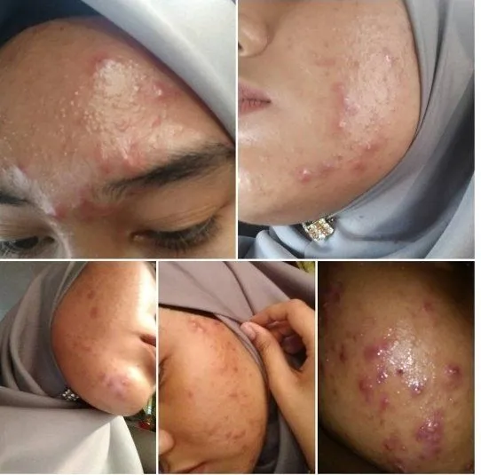 Stop Merawat Wajah dengan Produk Berbahan Kimia, Kalau Ogah Wajahmu Rusak Seperti Asmida! 11