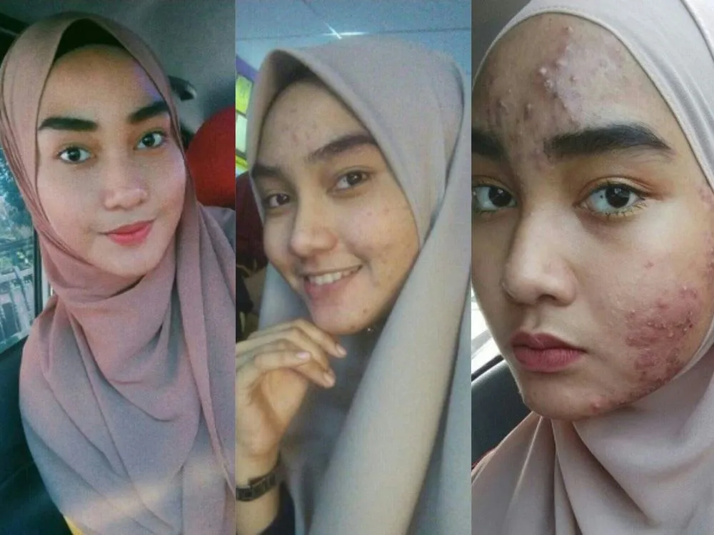 Stop Merawat Wajah dengan Produk Berbahan Kimia, Kalau Ogah Wajahmu Rusak Seperti Asmida!