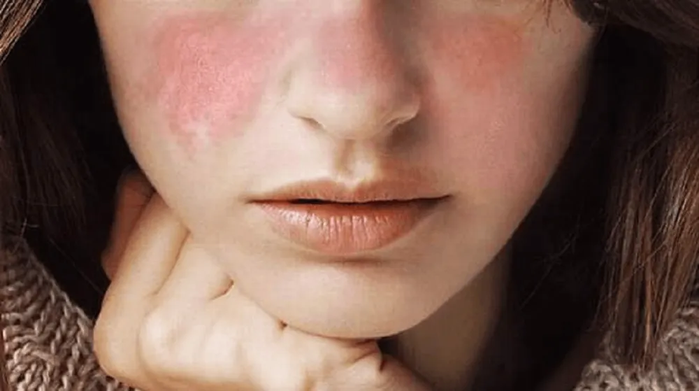 Lebih Akrab Sama Penyakit Lupus; 'Momok' yang Lebih Banyak Menyerang Wanita Daripada Pria 9