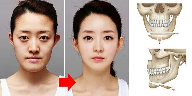 5 Jenis Oplas yang Bikin Paras Artis Korea Seakan Hampir Sempurna, Enak Yak Muka Bisa Diedit Sendiri 8