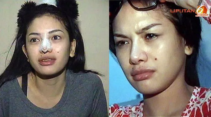 5 Jenis Oplas yang Bikin Paras Artis Korea Seakan Hampir Sempurna, Enak Yak Muka Bisa Diedit Sendiri 7