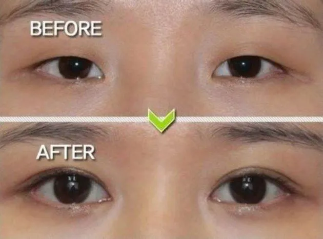 5 Jenis Oplas yang Bikin Paras Artis Korea Seakan Hampir Sempurna, Enak Yak Muka Bisa Diedit Sendiri 6
