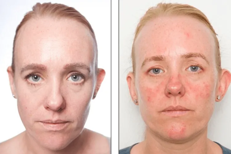 7 Kasus Kulit Rusak Akibat Pemakaian Make-Up. Jangan Sampai Kamu Mengalaminya! 9