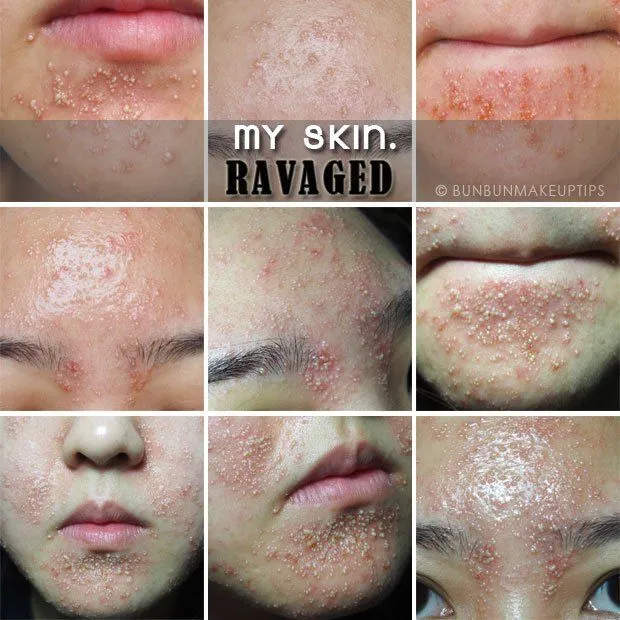 7 Kasus Kulit Rusak Akibat Pemakaian Make-Up. Jangan Sampai Kamu Mengalaminya! 13
