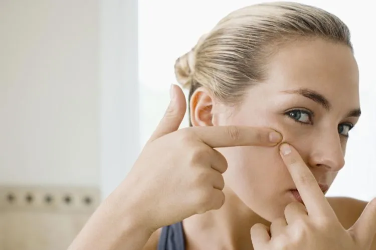 Suka Kaget Bangun Tidur Tiba-Tiba Muncul Jerawat di Muka? Atasi dengan 8 Cara Ini, Deh! 16