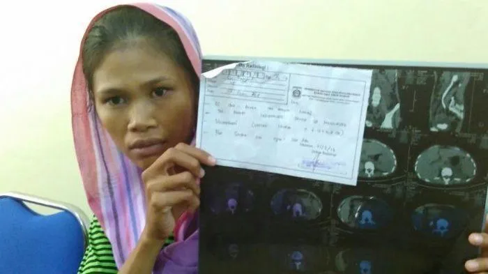 Mirisnya Nasib Pejuang Devisa Indonesia. Setelah 3 Tahun, TKW Ini Baru Sadar Ginjalnya Telah Dicuri 6