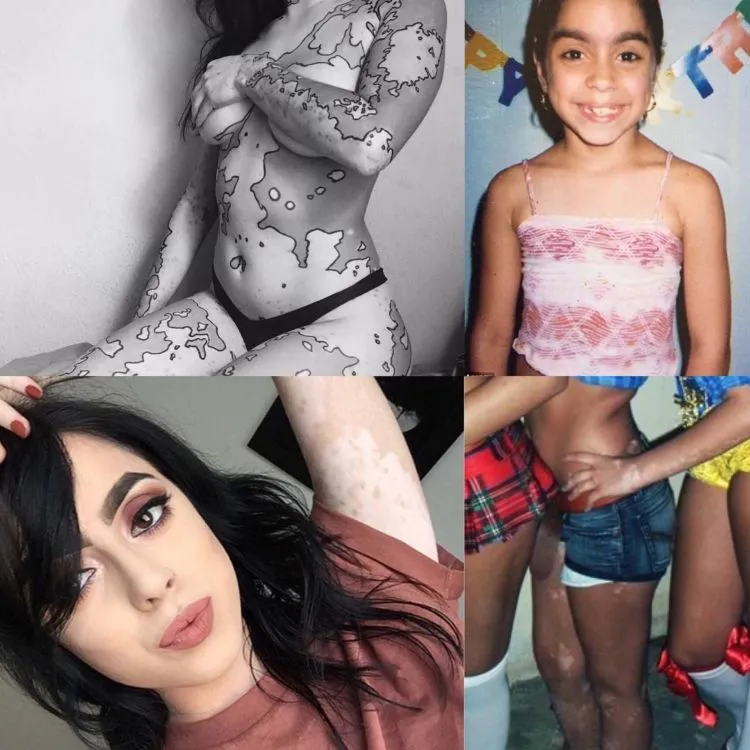 Awalnya Dibully, Kini Malah Dikagumi. Gadis Ini Ubah Kekurangan Tubuhnya Jadi Karya Seni 6