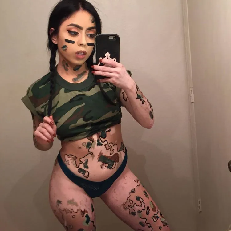 Awalnya Dibully, Kini Malah Dikagumi. Gadis Ini Ubah Kekurangan Tubuhnya Jadi Karya Seni 8