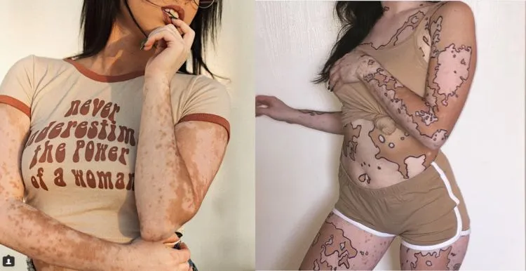 Awalnya Dibully, Kini Malah Dikagumi. Gadis Ini Ubah Kekurangan Tubuhnya Jadi Karya Seni 7