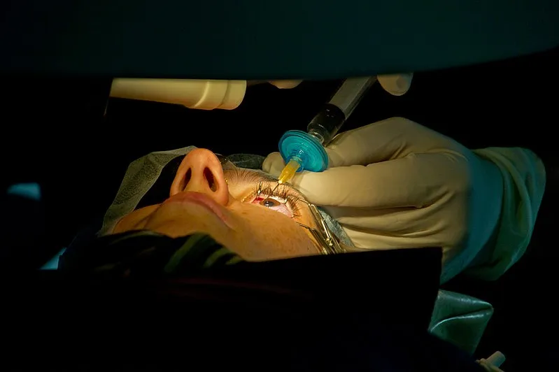 Mengenal Operasi Lasik Mata untuk Menajamkan Penglihatan. Mata Minus, Plus, atau Silinder Bisa 7