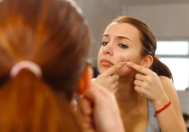Ada Terobosan Baru Buat yang Suka Jerawatan! Lupakan Skin Care Mahal, Kini Ada Vaksin Anti Jerawat 5