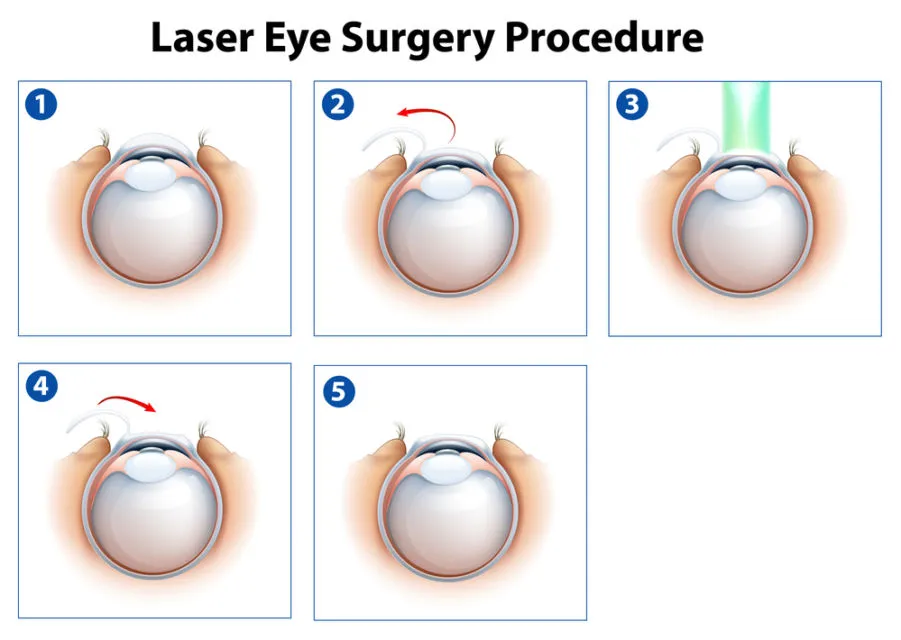 Mengenal Operasi Lasik Mata untuk Menajamkan Penglihatan. Mata Minus, Plus, atau Silinder Bisa 6