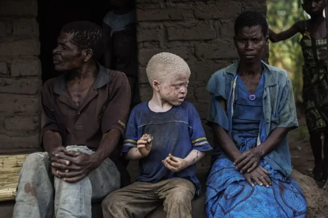 Kisah Sedih Orang Albino di Afrika, Diburu dan Dibunuh Karena Keunikannya. Ini 8 Faktanya 13