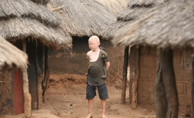 Kisah Sedih Orang Albino di Afrika, Diburu dan Dibunuh Karena Keunikannya. Ini 8 Faktanya 15
