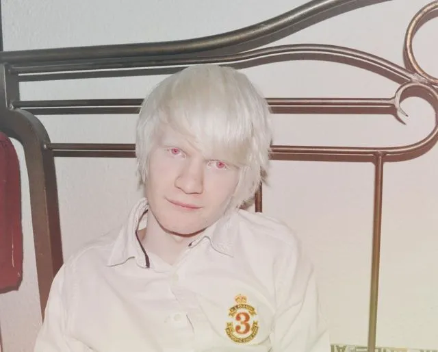 Kisah Sedih Orang Albino di Afrika, Diburu dan Dibunuh Karena Keunikannya. Ini 8 Faktanya 12