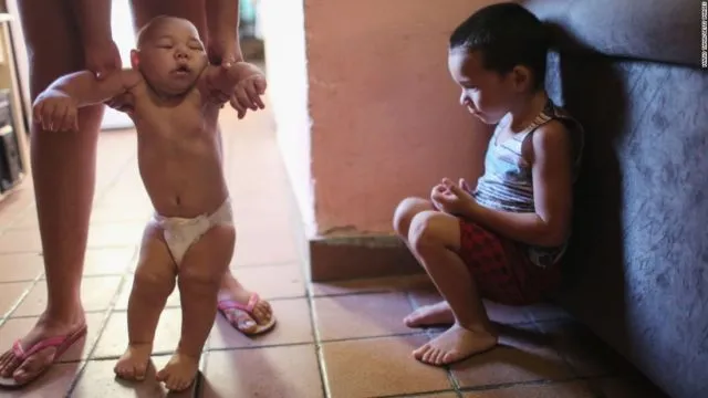12 Foto Korban Zika Ini Sungguh Memilukan. Meski Situasi Darurat Sudah Lewat, Tetap Perlu Waspada 20