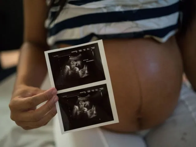 12 Foto Korban Zika Ini Sungguh Memilukan. Meski Situasi Darurat Sudah Lewat, Tetap Perlu Waspada 22