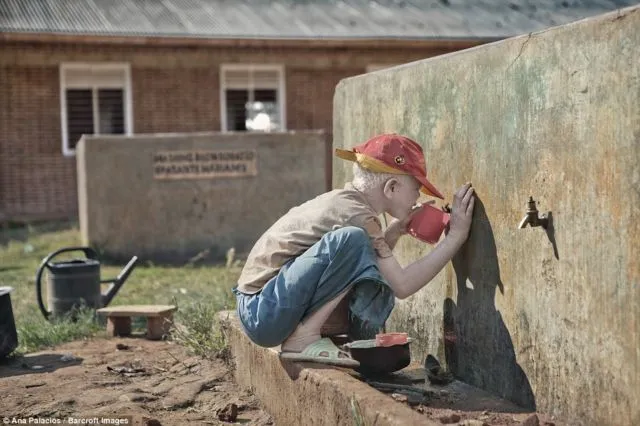 Kisah Sedih Orang Albino di Afrika, Diburu dan Dibunuh Karena Keunikannya. Ini 8 Faktanya 14