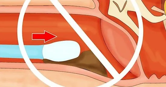 Banyak yang Salah Kaprah, Ternyata Bersihin Telinga Pakai Cotton Bud Itu Bahaya. Baca Deh Faktanya! 11