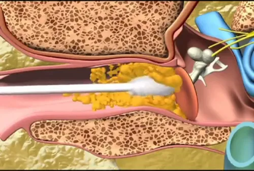 Banyak yang Salah Kaprah, Ternyata Bersihin Telinga Pakai Cotton Bud Itu Bahaya. Baca Deh Faktanya! 9