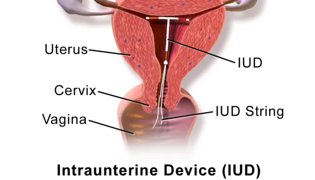 Mengenal Lebih Jauh Tentang IUD. Kok Bisa Sampai Ada Bayi Terlahir dengan Mengenggam Alat Kontrasepsi Ini? 14