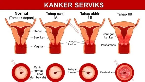 Kesehatan Rahim Itu Aset! Girls, Ketahui 5 Fakta Vaksin HPV Ini Demi Masa Depanmu 9