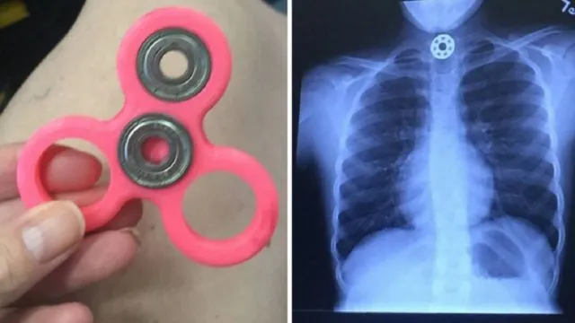 Nggak Cuma Smartphone, Kini Ada Juga Kasus Fidget Spinner yang Meledak! Wah Bahaya Nih 7
