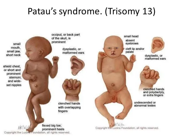 Kisah Bayi Mungil Adam Begitu Mengharukan. Ini Fakta yang Mesti Kamu Tahu Soal Penyakitnya 7