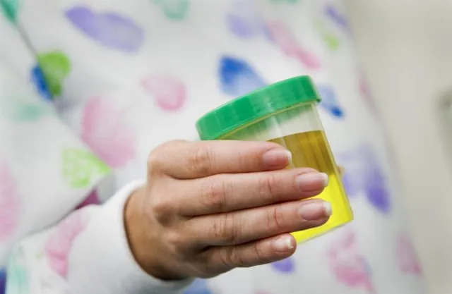 Waspadai Kesehatanmu dari 7 Jenis Warna Urine Ini. Mulai Tanda Dehidrasi Hingga Gejala Lever Dibahas di Sini 10