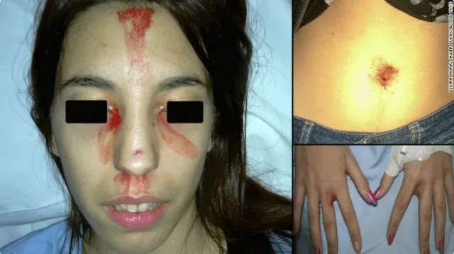 Cewek Ini Berkeringat Darah! Ternyata Begini Penjelasan Ilmiahnya 11
