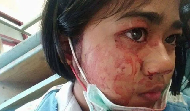 Cewek Ini Berkeringat Darah! Ternyata Begini Penjelasan Ilmiahnya 10