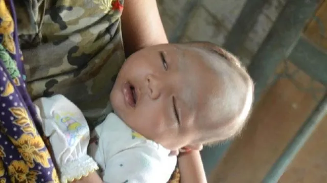 Diduga Karena Sering Dipijat, Bayi Ini Alami Pendarahan Otak 5