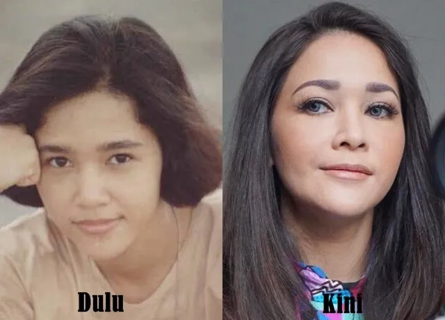 A-Z Prosedur Tanam Benang atau Thread Lift yang Perlu Kamu Tahu. Katanya Sih Bisa Bikin Tirus Instant 10