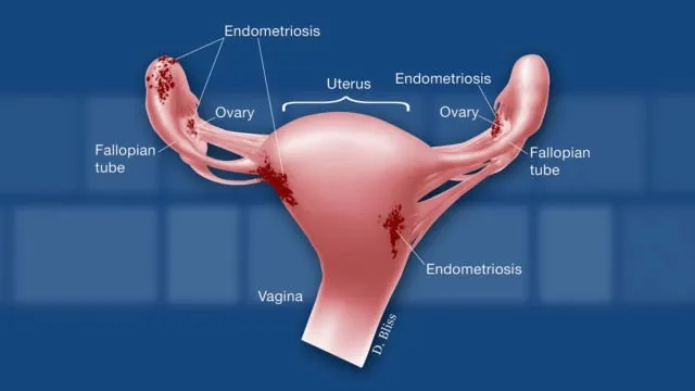Waspada Endometriosis dan Fibroid Seperti yang Dialami Oleh Zaskia Sungkar. Ini Penjelasannya! 7