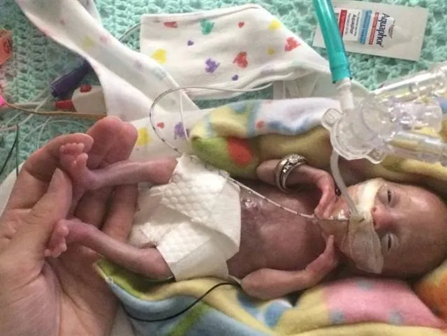 Berkat Teknologi Modern, Bayi Paling Prematur di Dunia Kini Berusia 3 Tahun. Inilah Keajaiban Modern 6