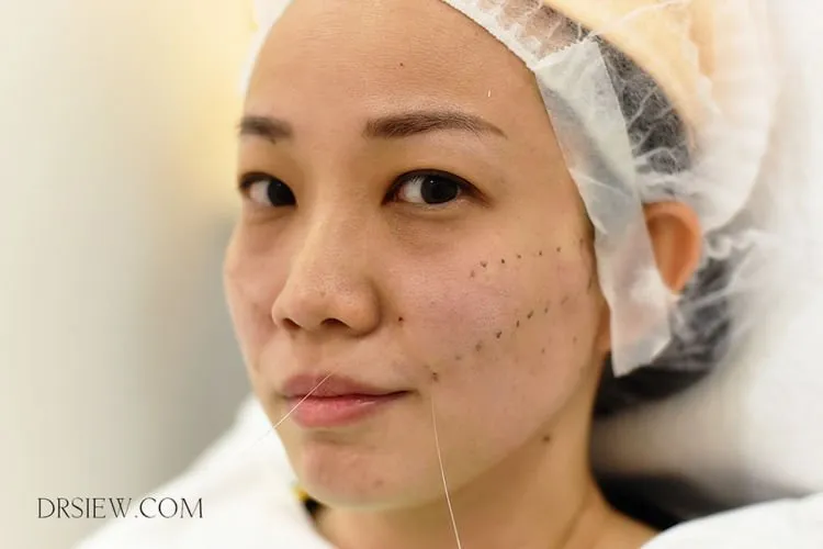 A-Z Prosedur Tanam Benang atau Thread Lift yang Perlu Kamu Tahu. Katanya Sih Bisa Bikin Tirus Instant 8