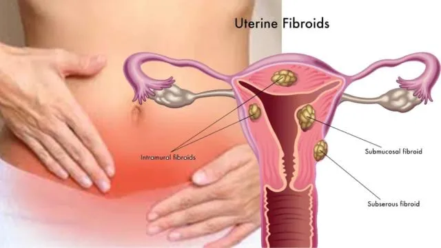 Waspada Endometriosis dan Fibroid Seperti yang Dialami Oleh Zaskia Sungkar. Ini Penjelasannya! 10