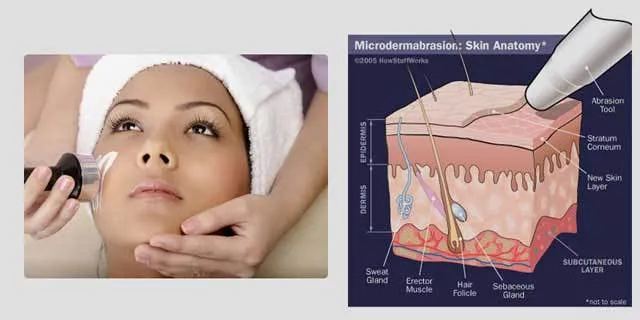 Menghilangkan Bopeng dan Bekas Jerawat Kini Bukan Lagi Mimpi. Vampire Facial Salah Satu Solusinya! 16