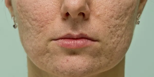 Menghilangkan Bopeng dan Bekas Jerawat Kini Bukan Lagi Mimpi. Vampire Facial Salah Satu Solusinya! 10