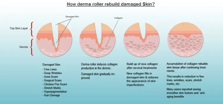 Menghilangkan Bopeng dan Bekas Jerawat Kini Bukan Lagi Mimpi. Vampire Facial Salah Satu Solusinya! 14
