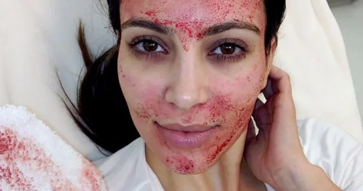 Menghilangkan Bopeng dan Bekas Jerawat Kini Bukan Lagi Mimpi. Vampire Facial Salah Satu Solusinya! 11