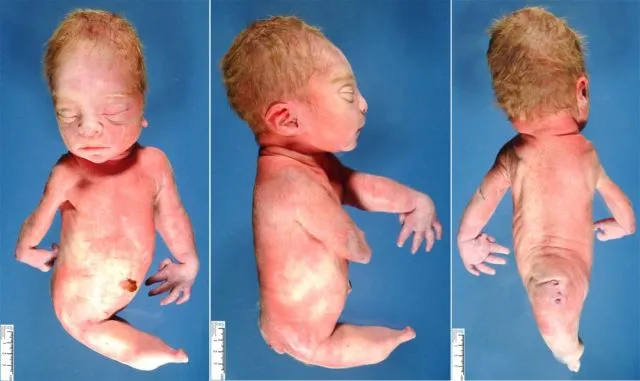 Bayi di India Lahir dengan Kaki Menyatu Mirip Putri Duyung. Ternyata Sindrom Ini Penyebabnya 7