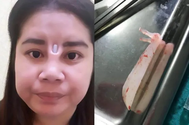Pengen Mancung Malah Kena Apes. Sisi Gelap Operasi Plastik Thailand yang Bikin Bergidik 6