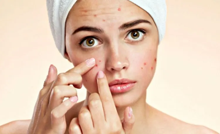 6+ Tips Ampuh Hilangkan Jerawat Level Frustasi dengan Cepat. Simak dan Terapkan dengan Cermat Ya! 12